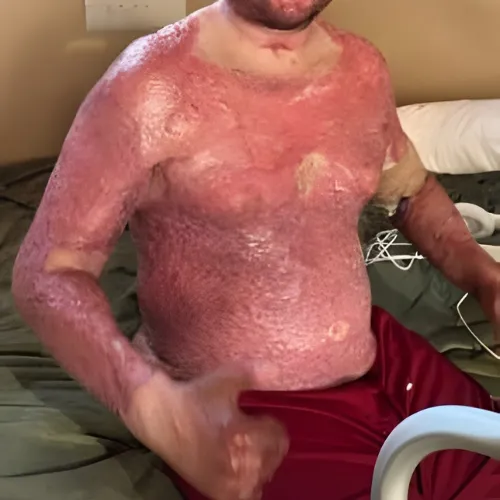 Gilberto com queimaduras